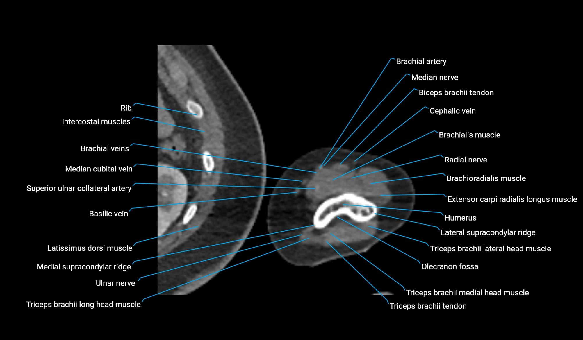 CT upper arm axial  cross sectional anatomy labelled radiology image -00366.webp